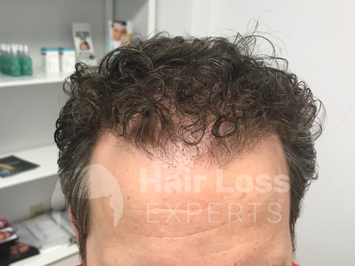 After: Hair transplant before and after result