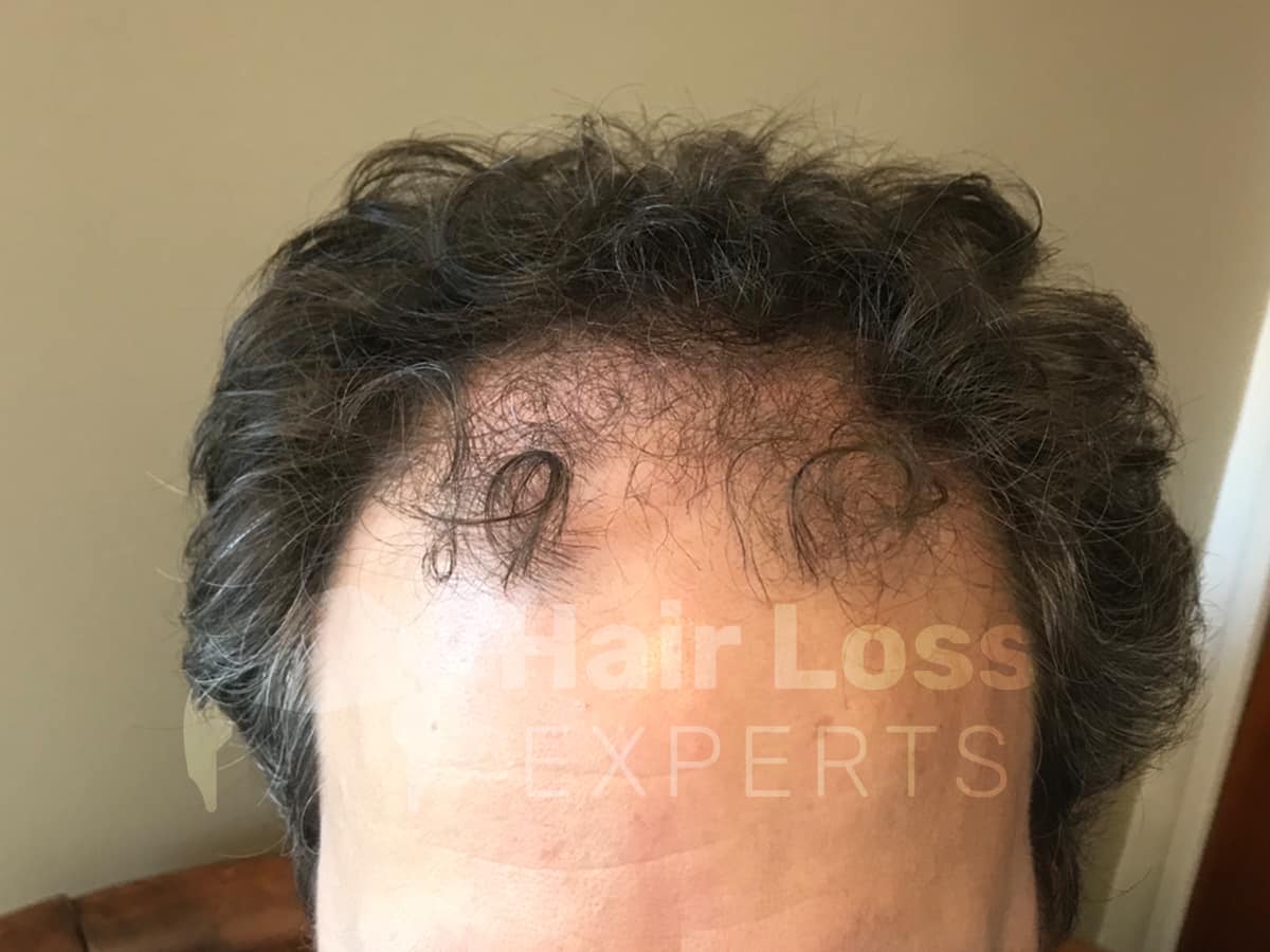 Before: Hair transplant before and after result